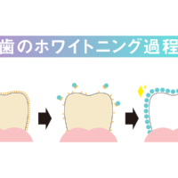 歯のホワイトニング