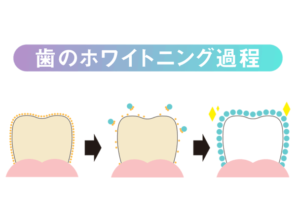歯のホワイトニング